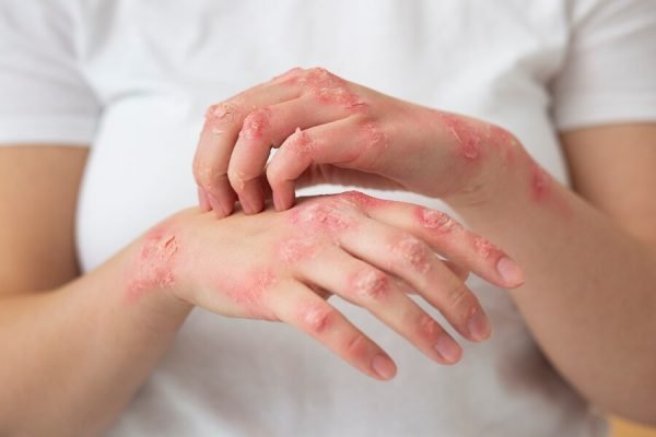hands-patient-suffering-from-psoriasis_23-2149322101